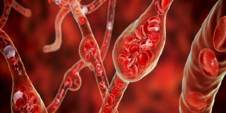 علامات تحذيرية لارتفاع الكوليسترول وأسبابه الشائعة