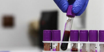 الصحة الروسية تسجل دواء مناعيا مبتكرا لعلاج سرطان الرئة سينتج محليا بالكامل