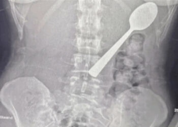 بسبب قفزة كلب.. شابة تبتلع ملعقة طولها 17 سنتيمتراً