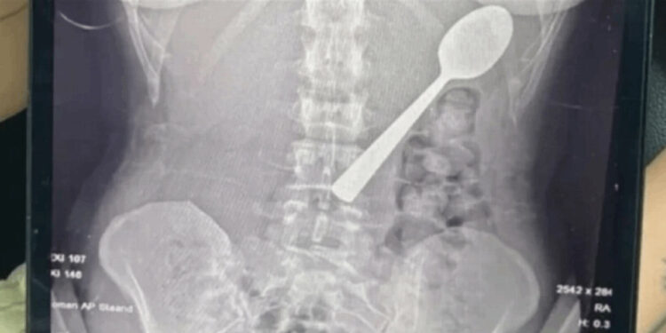 بسبب قفزة كلب.. شابة تبتلع ملعقة طولها 17 سنتيمتراً